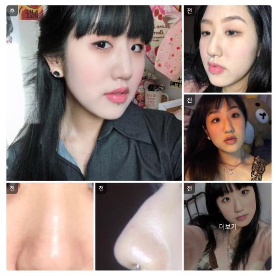 [바비톡] 코성형 / 1개월차/ 닉네임:김민지1111