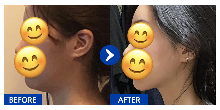 [바비톡] 얼굴지방흡입 / 1개월차/ 닉네임:바비톡히