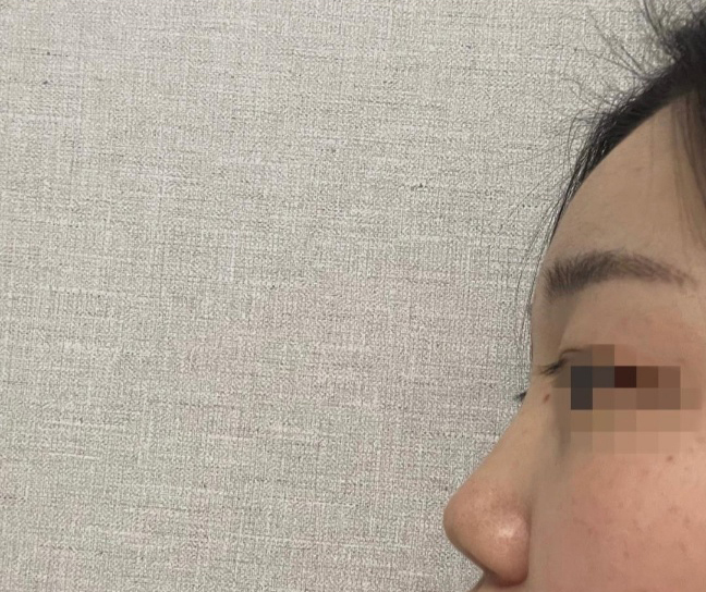 [Mắt] wlswn1 - Mũi