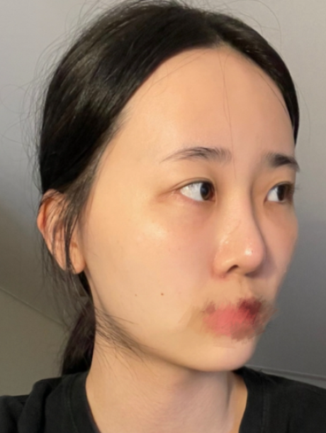 [Mắt] Gấu bông - Mắt, Đường nét khuôn mặt, Cấy mỡ