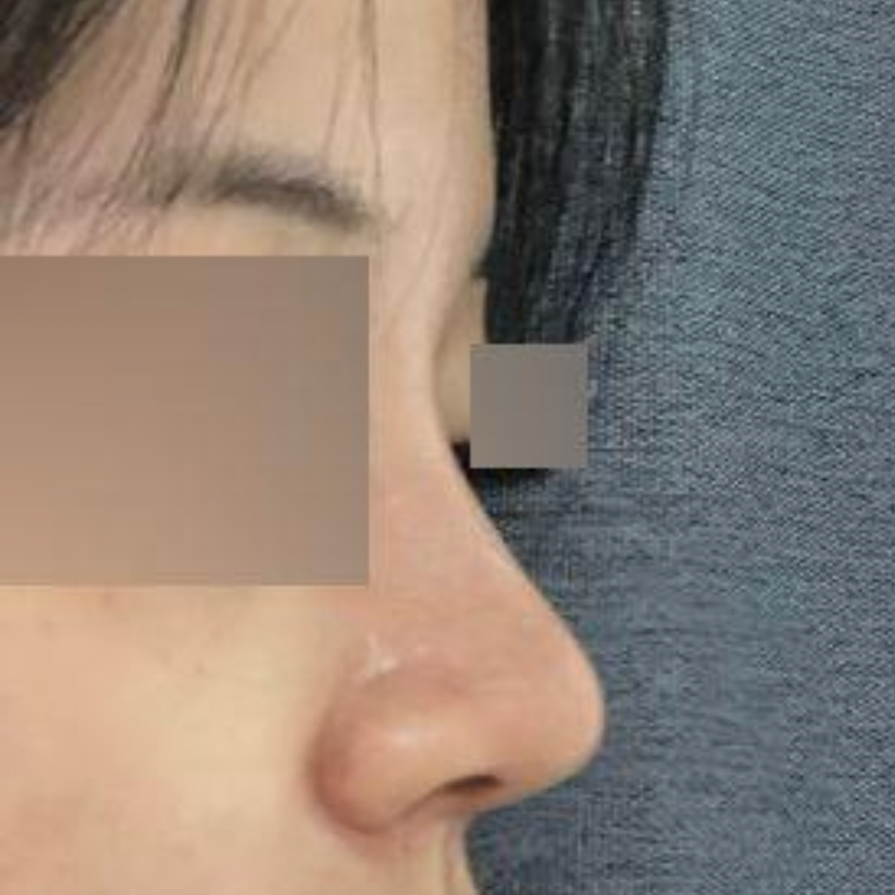 Đánh giá sau một tháng nâng mũi tại viện thẩm mỹ Weavers