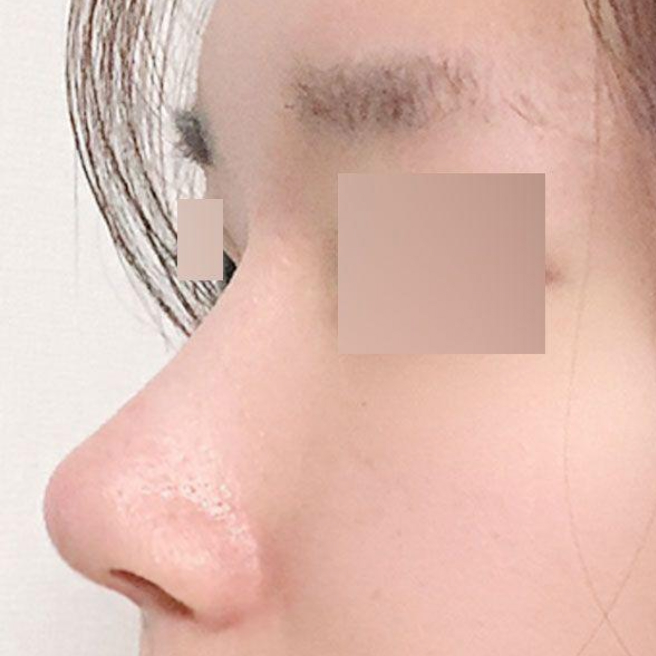 Đánh giá một tháng sau phẫu thuật mũi gồ nhỏ và bị ép