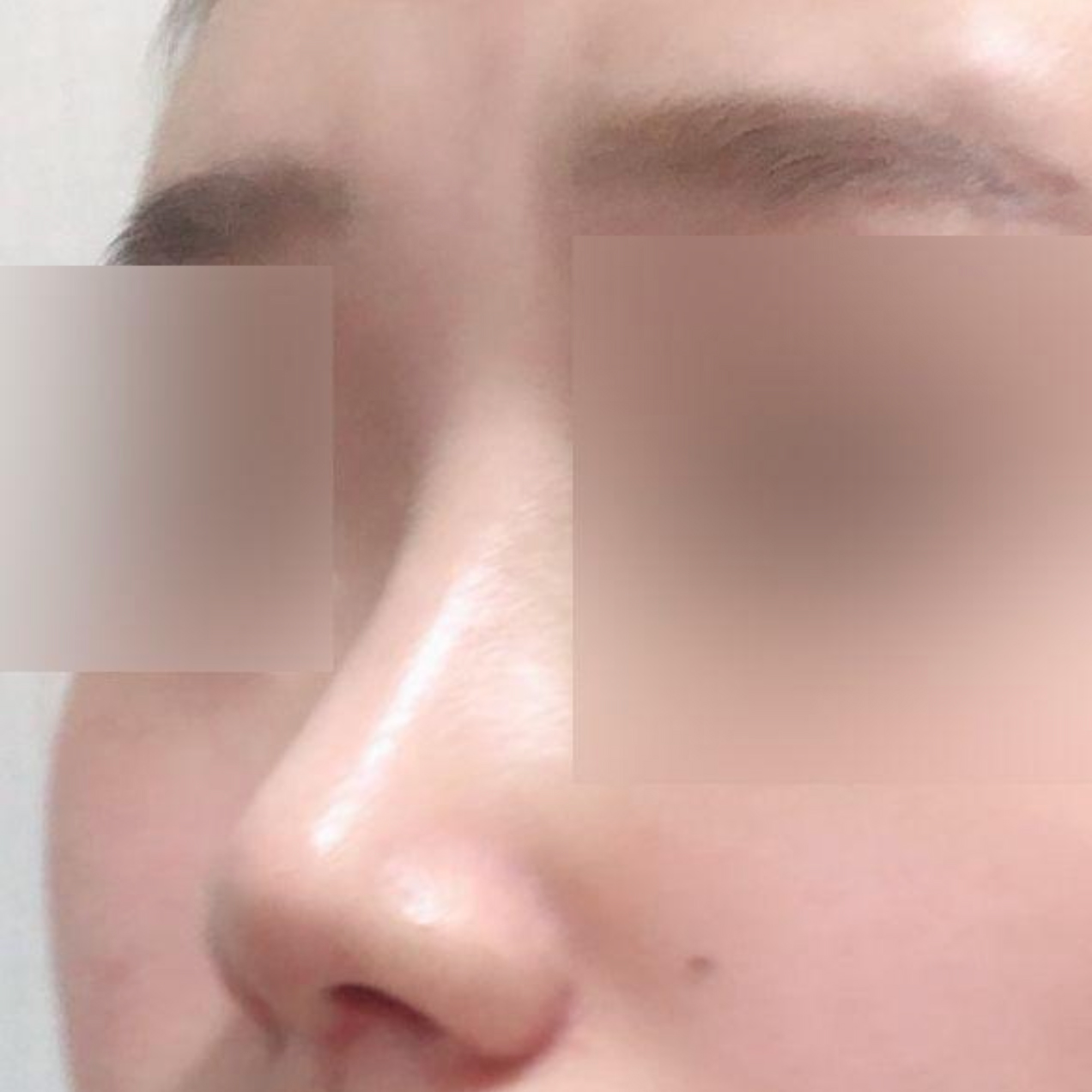 Đã hai tháng kể từ khi mình phẫu thuật lại mũi