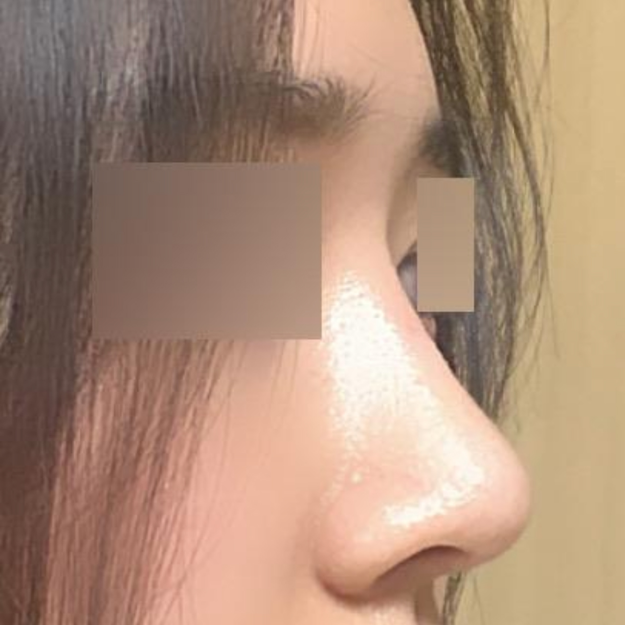 Mình đã sửa mũi lệch và mũi to