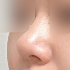 Đánh giá phẫu thuật chỉnh sửa mũi to không dùng chất liệu độn