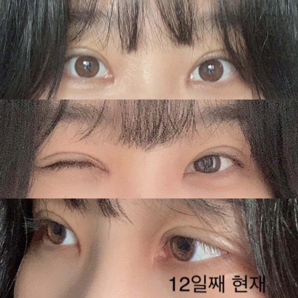 Bài đánh giá chân thực về sự hài lòng thực sự sau khi phẫu thuật mắt hai mí lại