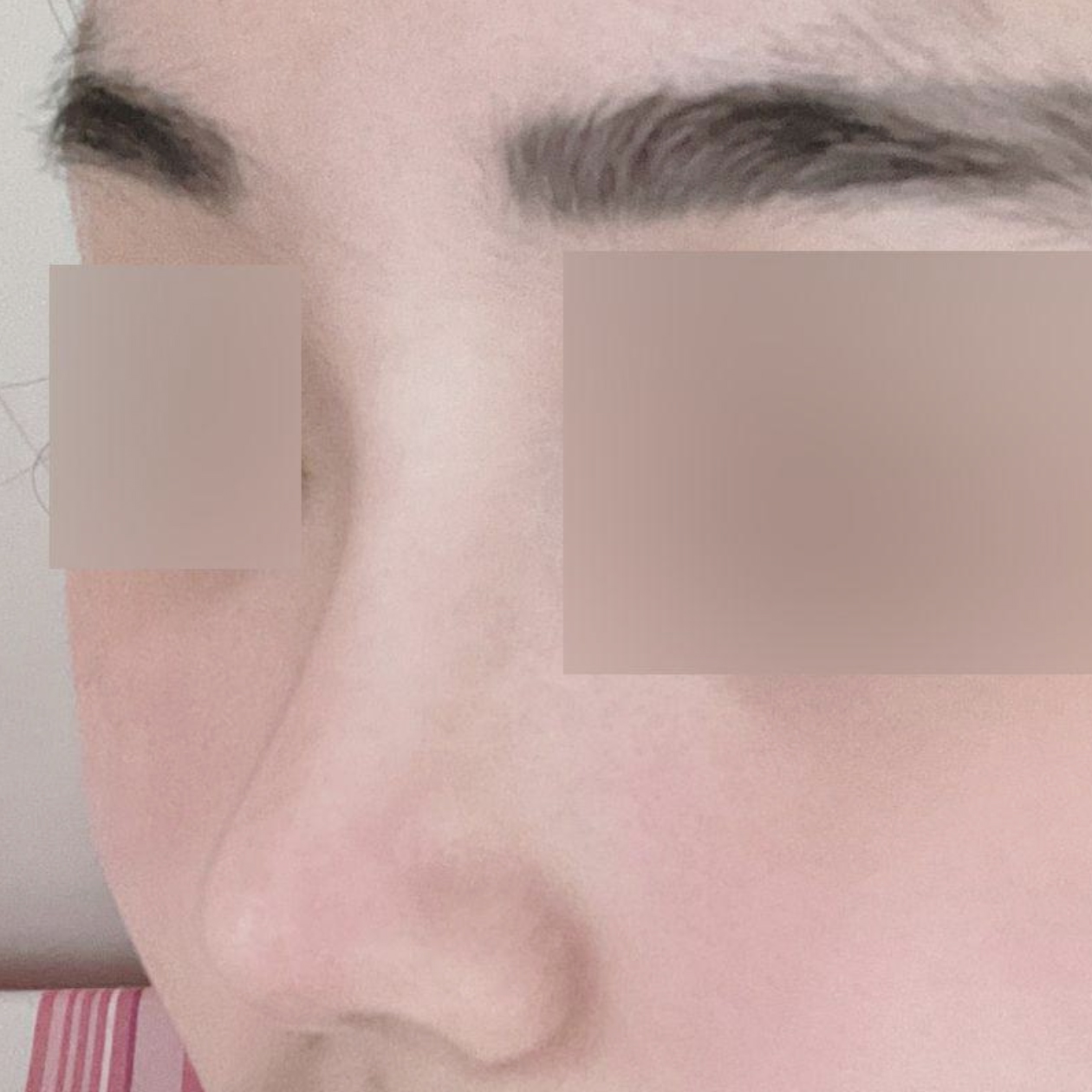 Đã 3 tháng kể từ khi phẫu thuật mũi ngắn + mũi chức năng!