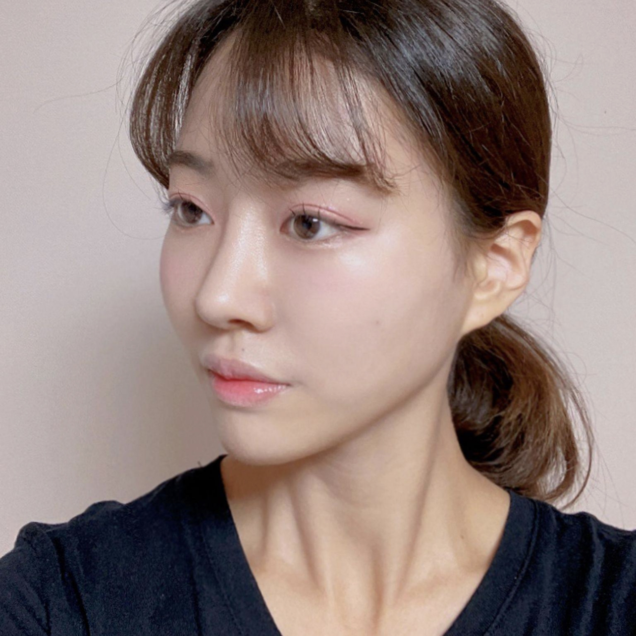 Mình đã phẫu thuật lại mũi tại Bệnh viện Thẩm mỹ Wevers được hai tháng rồi