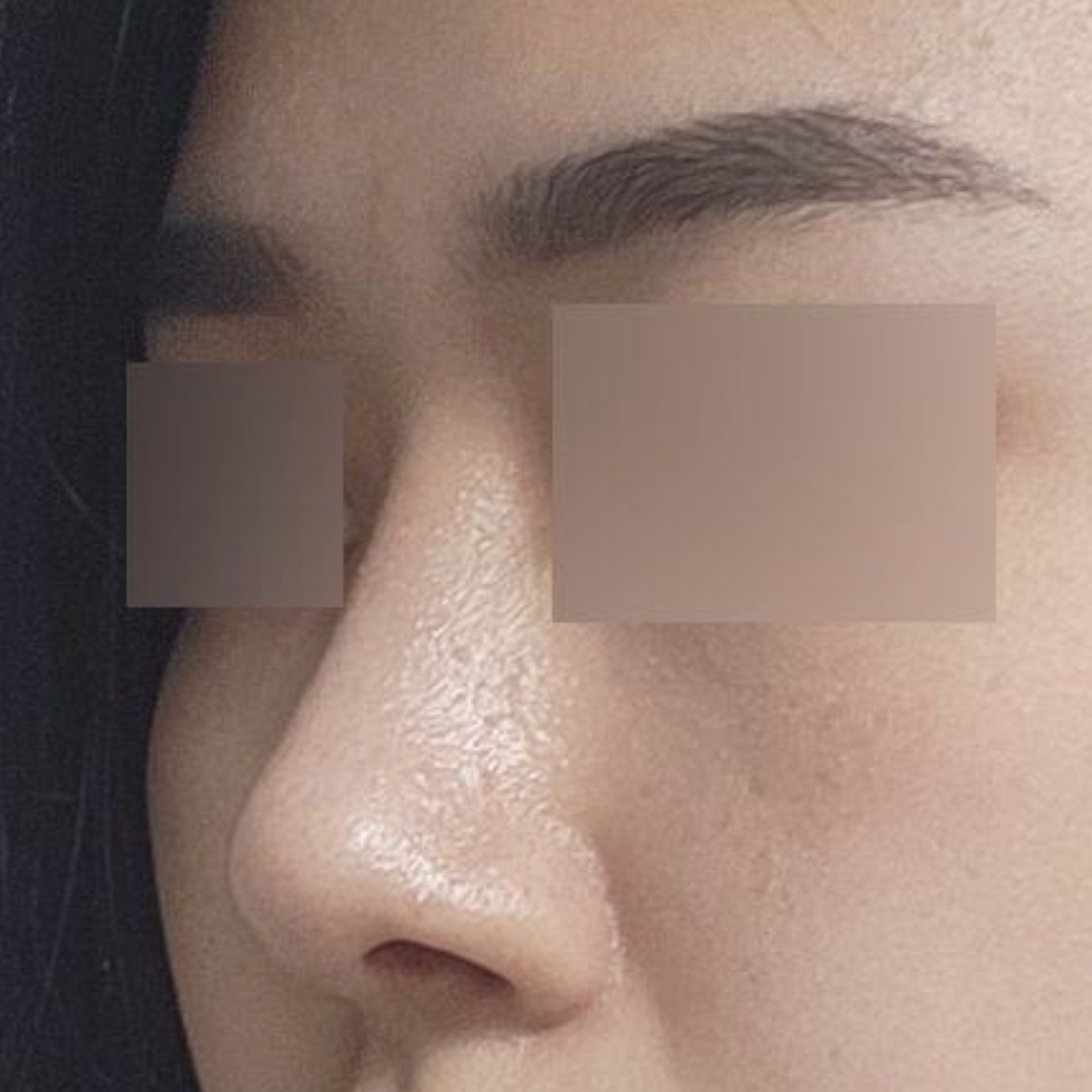 Đã 2 tháng kể từ khi phẫu thuật thu nhỏ đầu mũi!