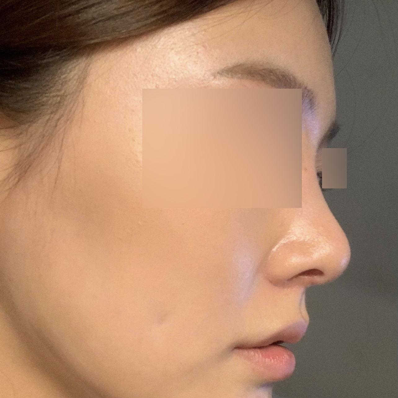 Nâng mũi hai tháng, không thể so sánh với tiêm filler