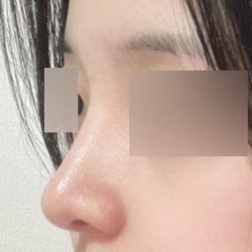 Đã 3 tháng kể từ khi mình phẫu thuật ở Wevers