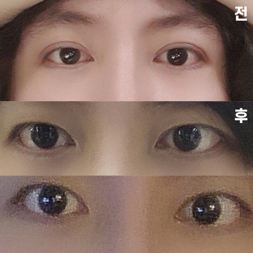 Tình trạng sau hạ đường viền mí đôi