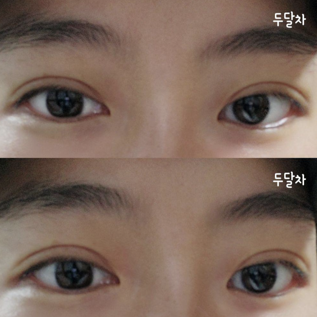 Đánh giá thật sau 2 tháng phẫu thuật mắt ~^^