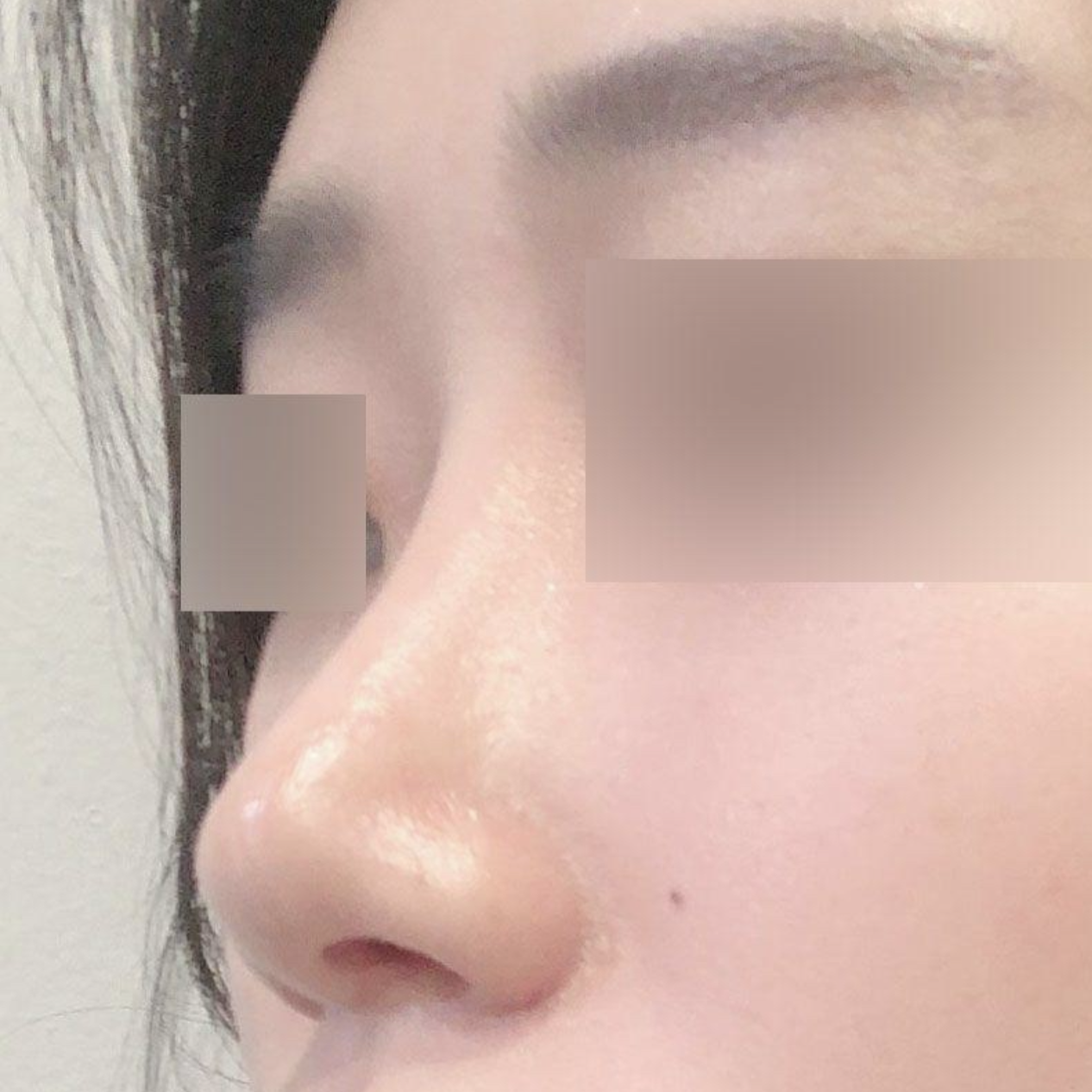 Mình đã phẫu thuật nâng mũi được 3 tháng rồi!!!