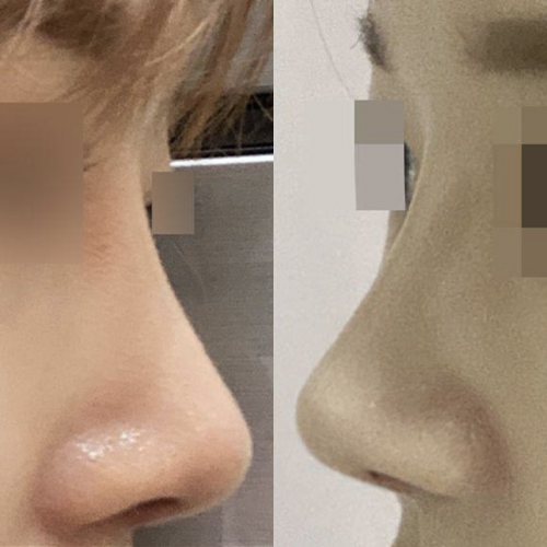 Đã 3 tháng kể từ khi mình phẫu thuật mũi