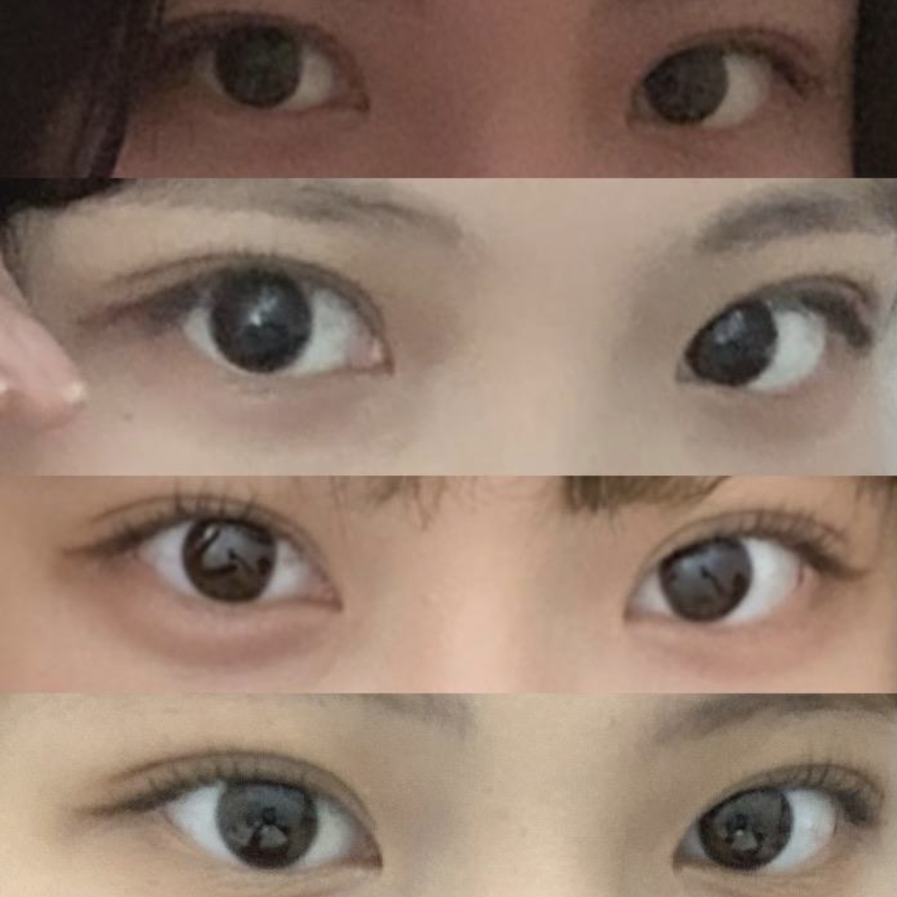 (Khâu dính tự nhiên, chỉnh hình mắt, mở góc mắt trong) Đã phẫu thuật được 4 tháng