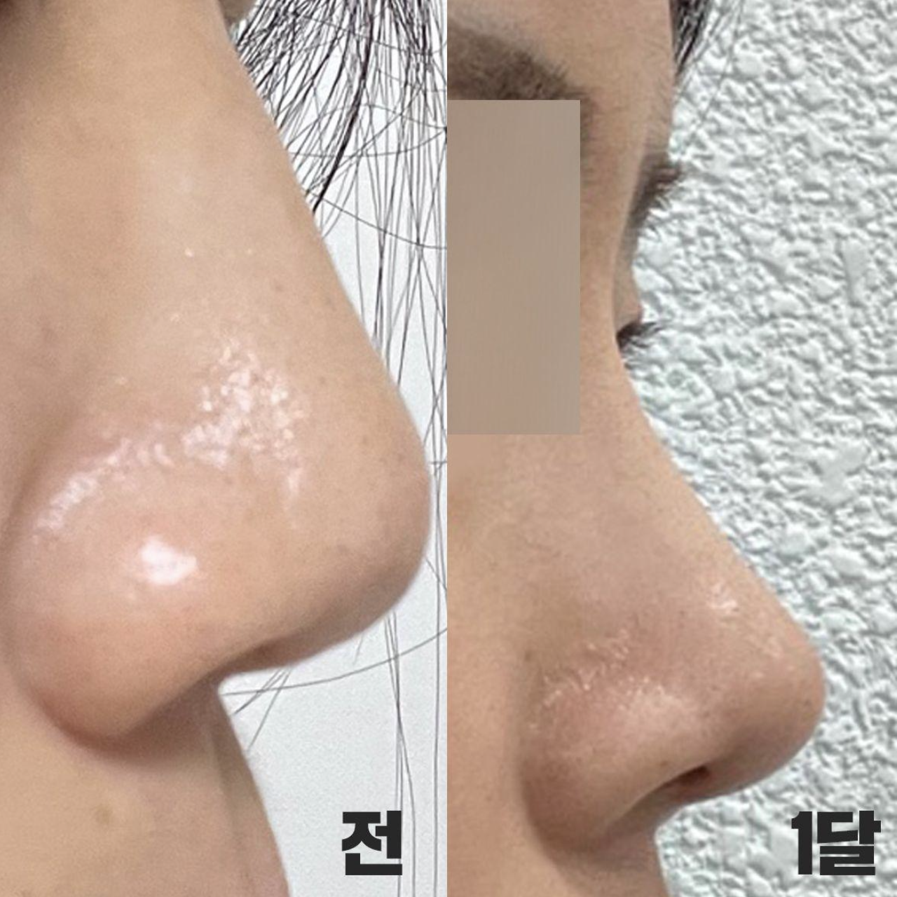 Một tháng sau phẫu thuật nâng mũi dáng thẳng