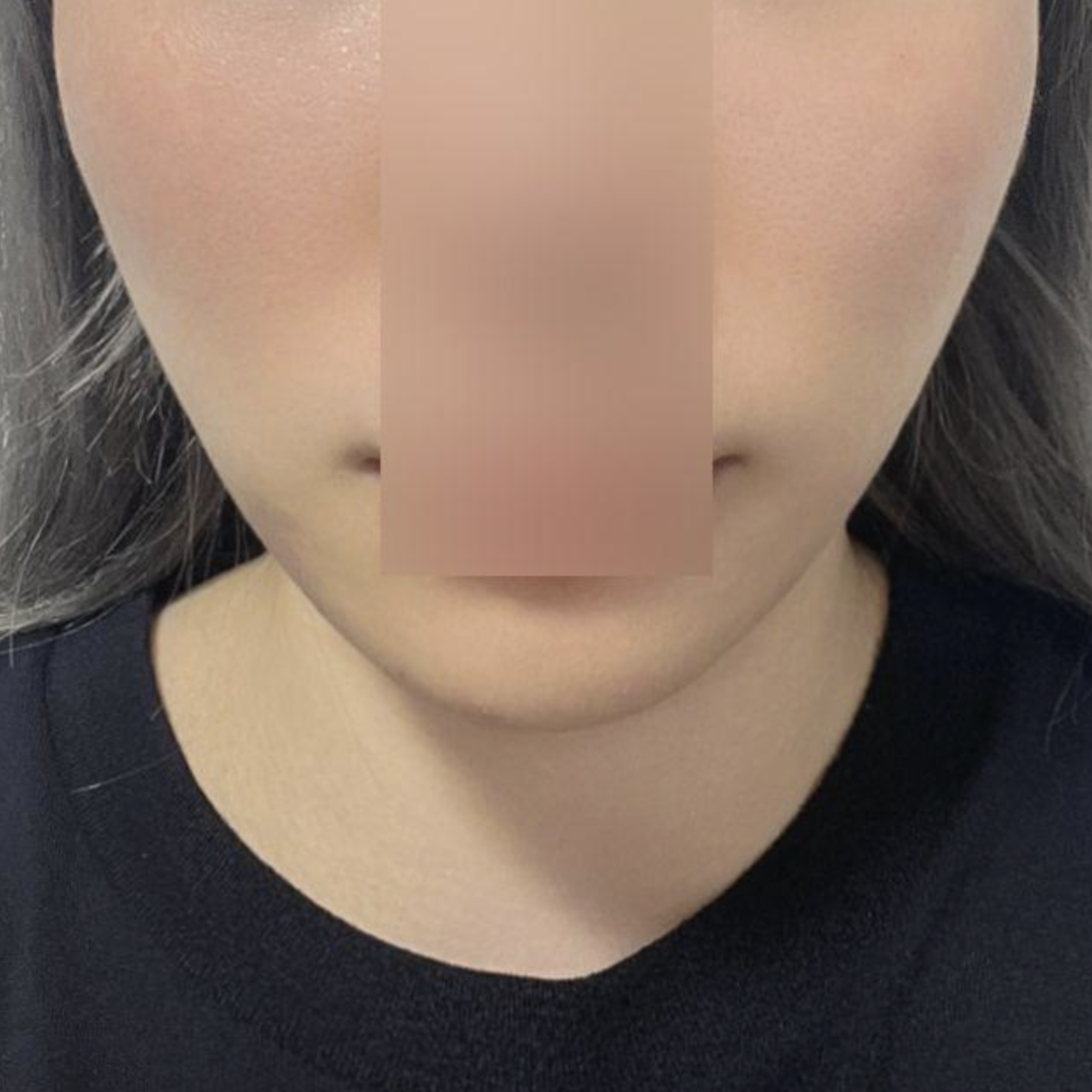 Mình đã giải quyết được nếp nhăn quanh miệng khiến mình lo lắng rồi đây~