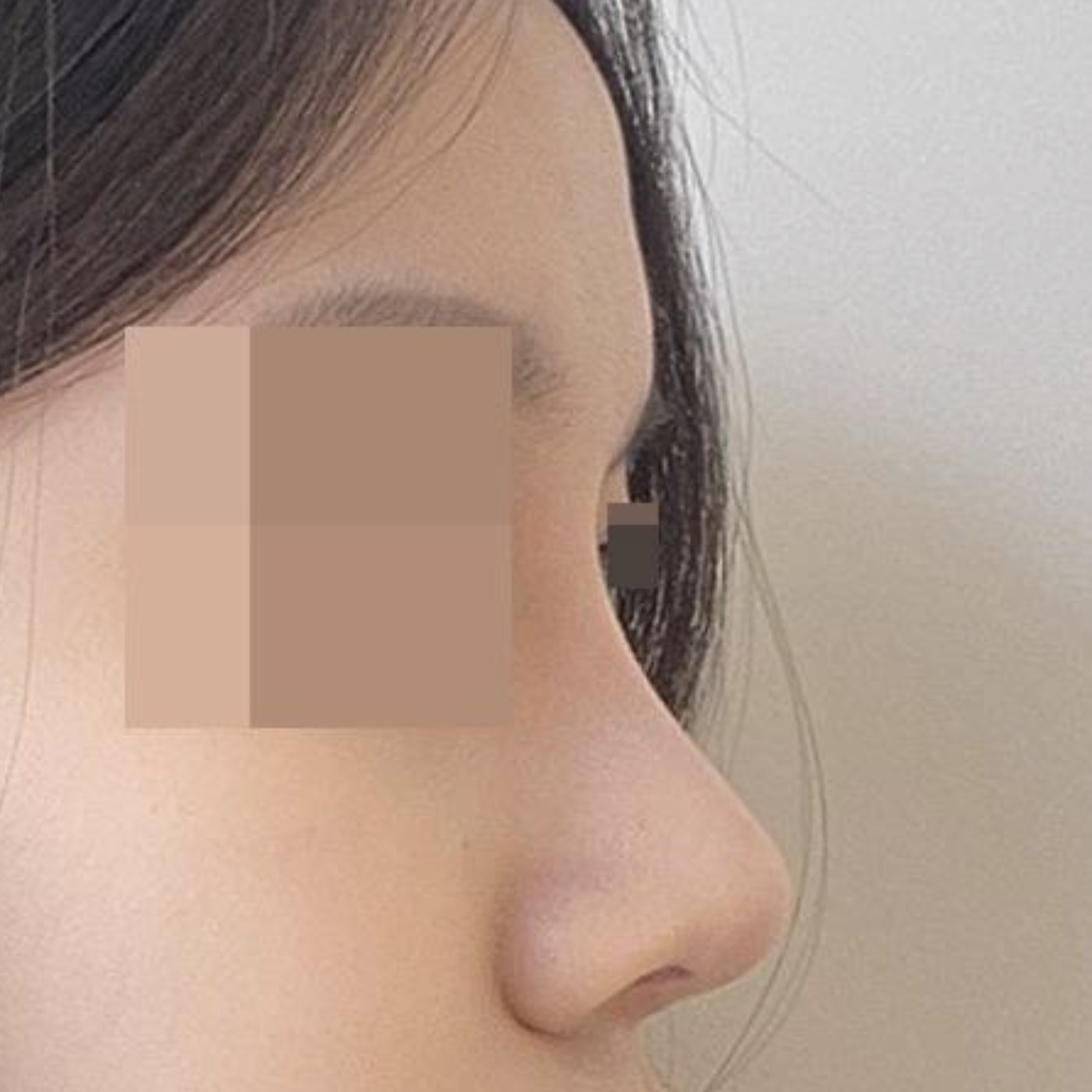 Đánh giá sau 3 tháng phẫu thuật mũi!