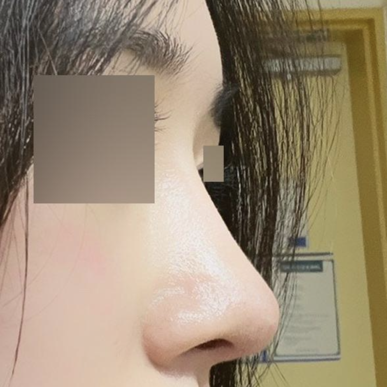 Mình đã phẫu thuật với bác sĩ Shim Jung-hwan được 4 tháng rồi!