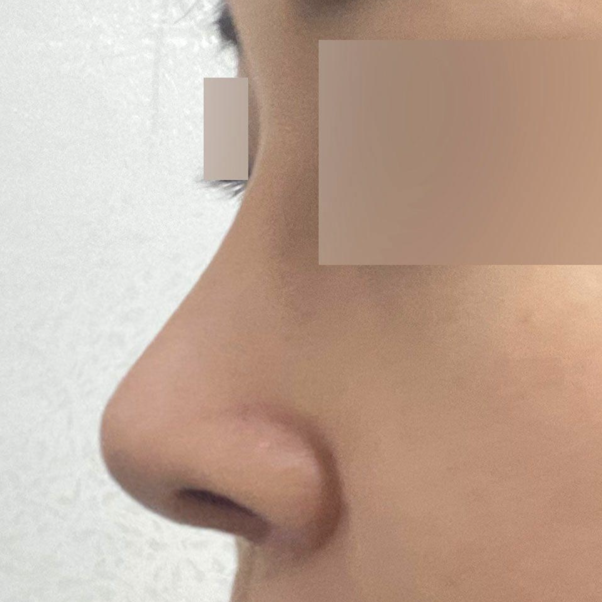 Mình đã phẫu thuật lại mũi bị véo