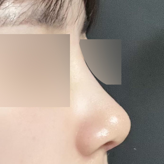 Chiếc mũi từng là mặc cảm của mình đã trở nên xinh đẹp!