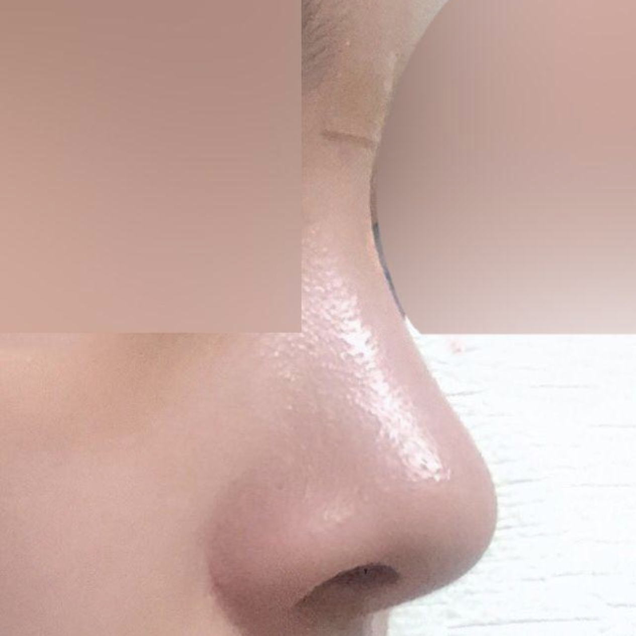 Đánh giá sau 3 tháng phẫu thuật mũi