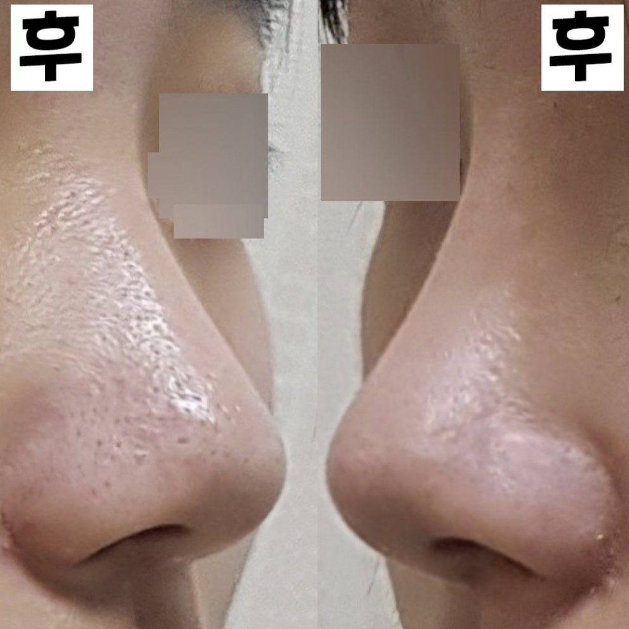 Đã 2 tuần kể từ ca phẫu thuật mũi đầu tiên của mình!