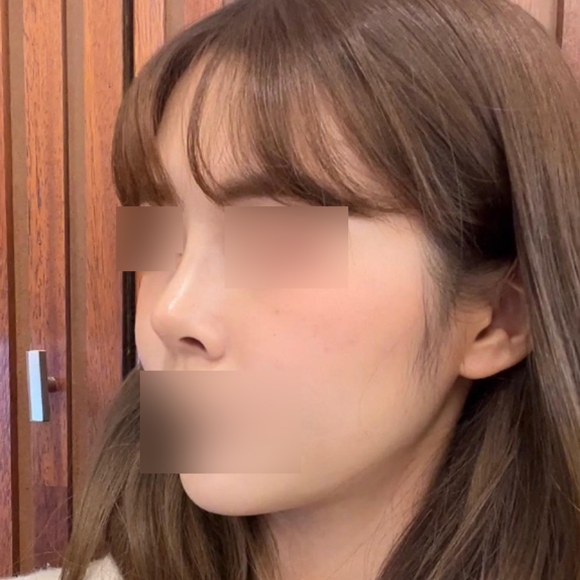 Sau phẫu thuật, mình nhận được rất nhiều lời khen từ mọi người xung quanh