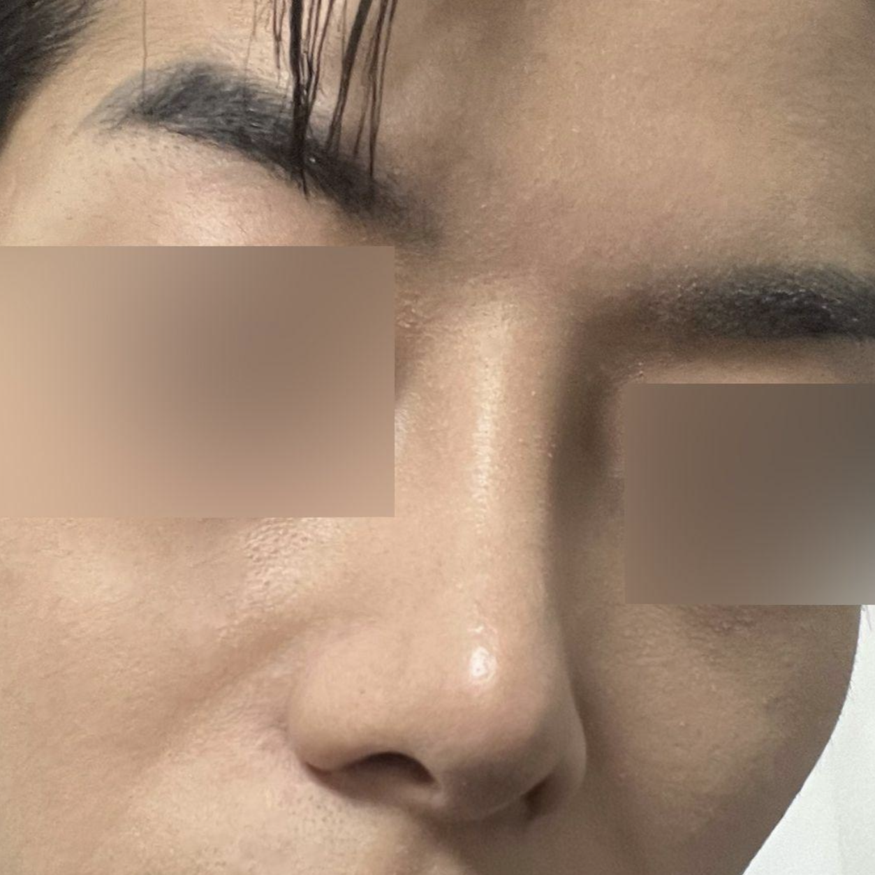 Mình thực sự hài lòng với ca phẫu thuật lại mũi to.