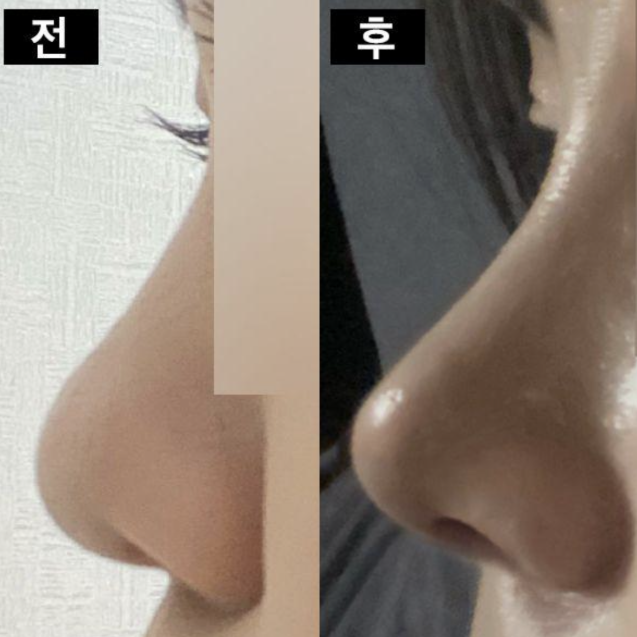 Đã được 1 tháng kể từ khi phẫu thuật mũi rồi đó ㅎ