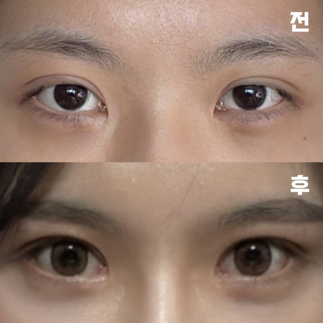 Mình đã mong chờ diện mạo sau khi hết sưng từ bây giờ