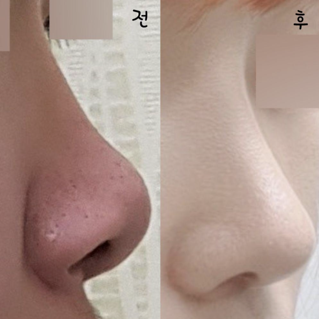 Mình đã tự tin hơn sau khi phẫu thuật!!