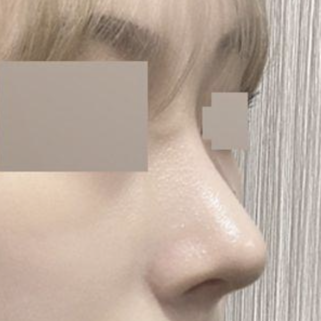 Đã phẫu thuật được 2 tháng rồi đó ạ!!