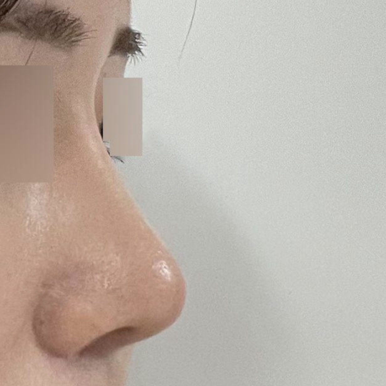 Đã được 3 tháng kể từ khi mình phẫu thuật mũi!