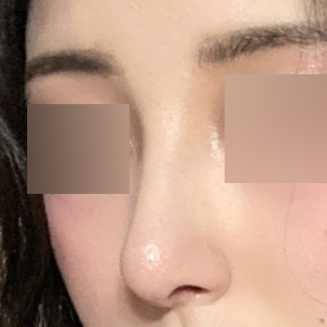 Đã được một tháng kể từ khi phẫu thuật.