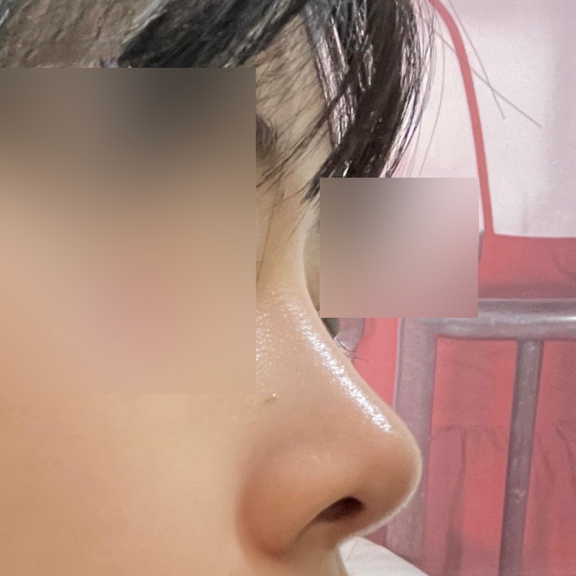 Đánh giá 6 tháng sau phẫu thuật nâng mũi!