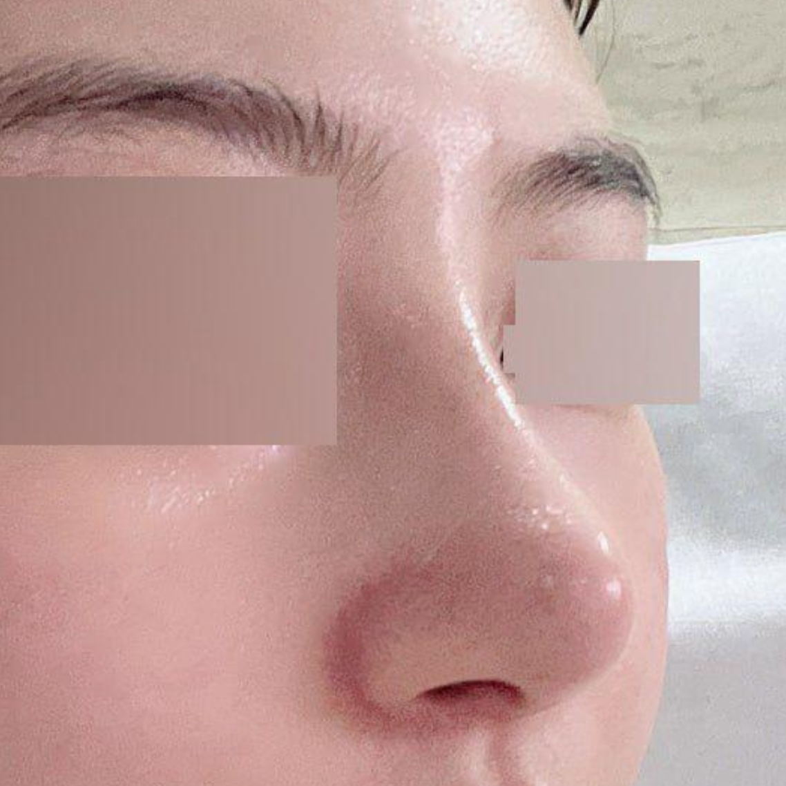 Cảm ơn bác sĩ Seo Seung-jo đã tạo cho mình chiếc mũi mơ ước!