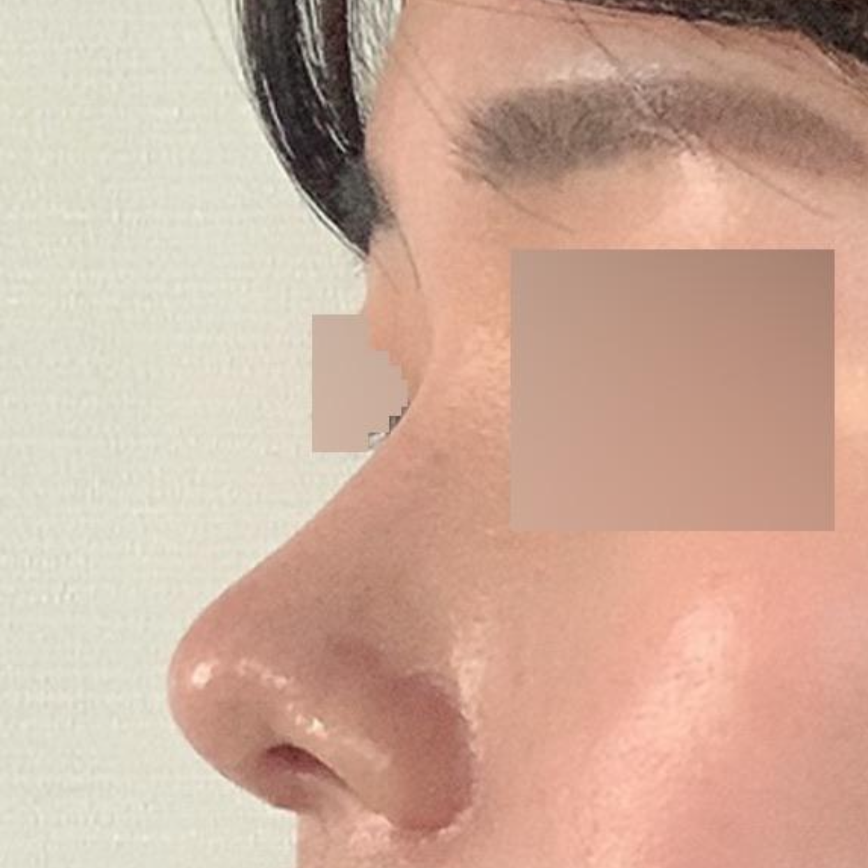 Review sau một tháng phẫu thuật mắt và mũi tại bệnh viện thẩm mỹ Weaver!!