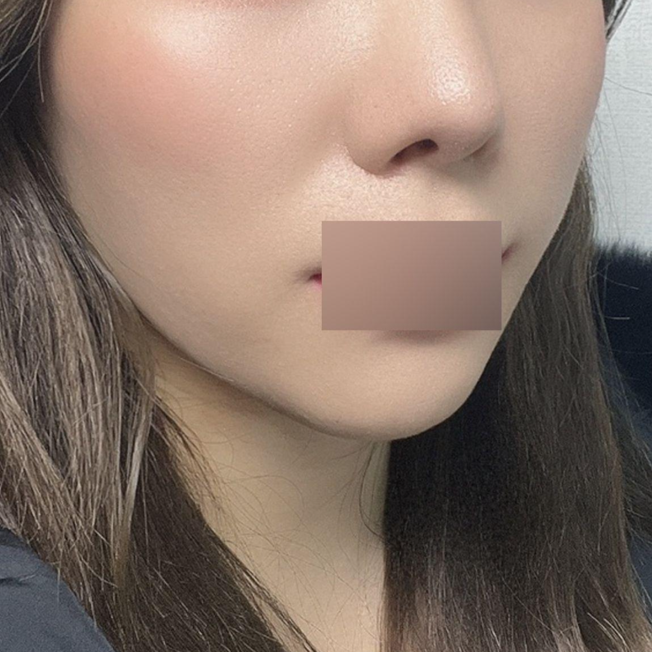 Đã 3 tháng kể từ khi thực hiện căng chỉ Peach