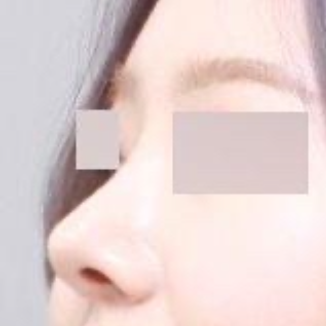 Đã 6 tháng kể từ khi phẫu thuật chỉnh sửa mũi gồ ghề rồi đó ㅎㅎ