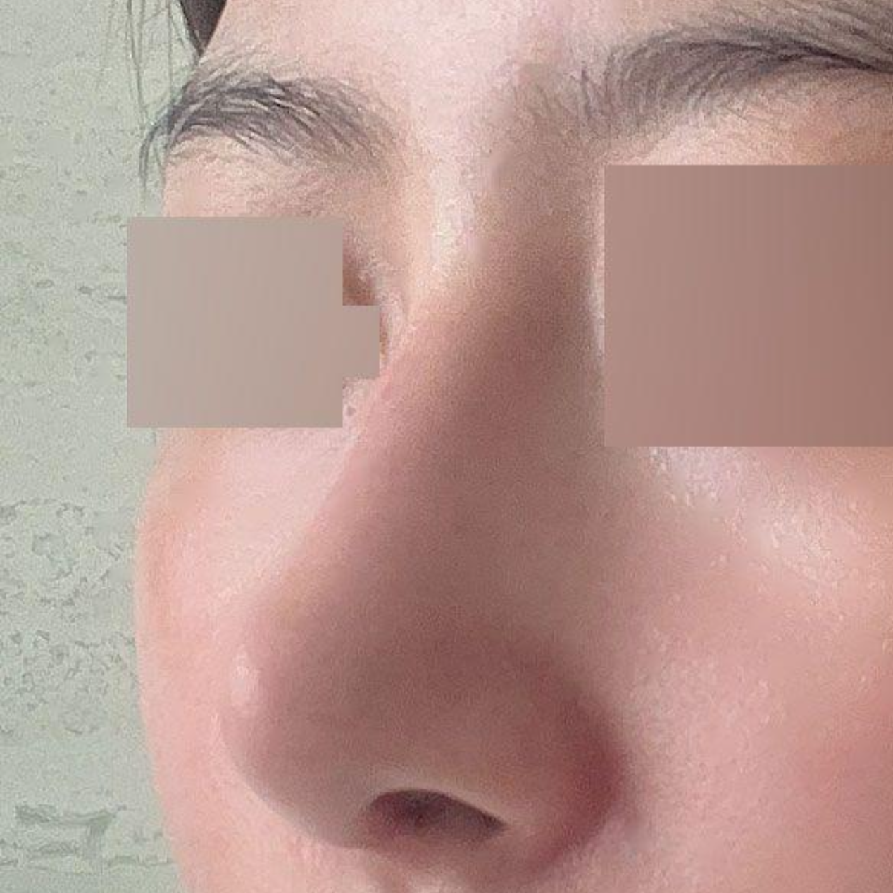 Cảm ơn bác sĩ Seo Seung-jo đã giúp mình có một chiếc mũi mới!