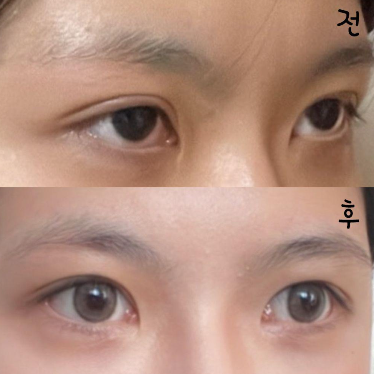 Mình đã tái phẫu thuật mắt tại bệnh viện thẩm mỹ Weavers ở ga Gangnam được hai tháng rồi!