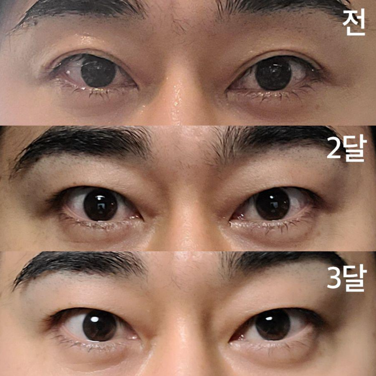 Mình đã phẫu thuật cắt mí mắt kép được 3 tháng.