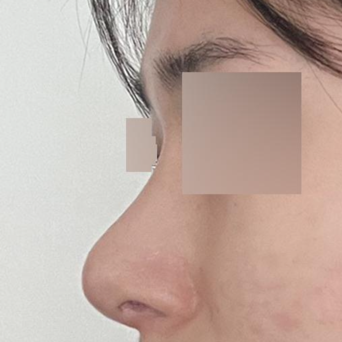 Mình đã phẫu thuật mũi tại Bệnh viện phẫu thuật thẩm mỹ Weavers được hai tháng rồi.