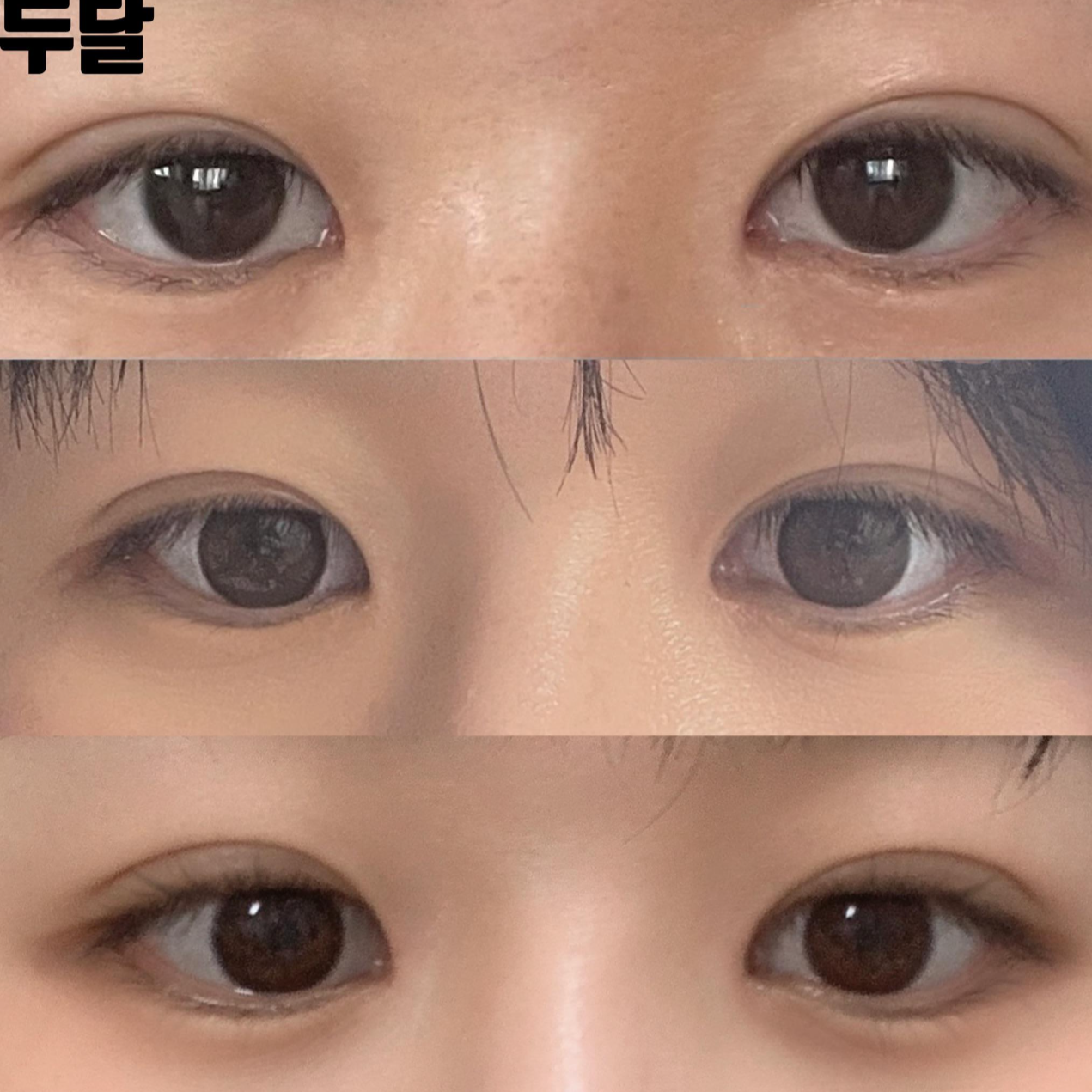 Chia sẻ sau hai tháng phẫu thuật mắt và mũi với bác sĩ Shim Jung-hwan