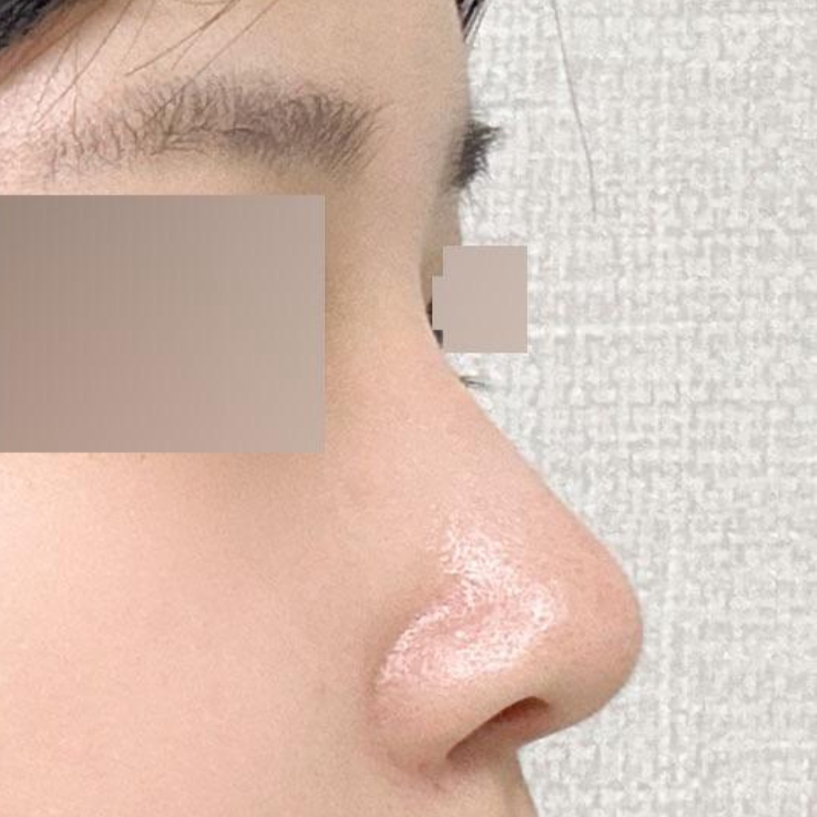 Hôm nay là ngày thứ hai sau phẫu thuật tại Bệnh viện phẫu thuật thẩm mỹ Weavers ~