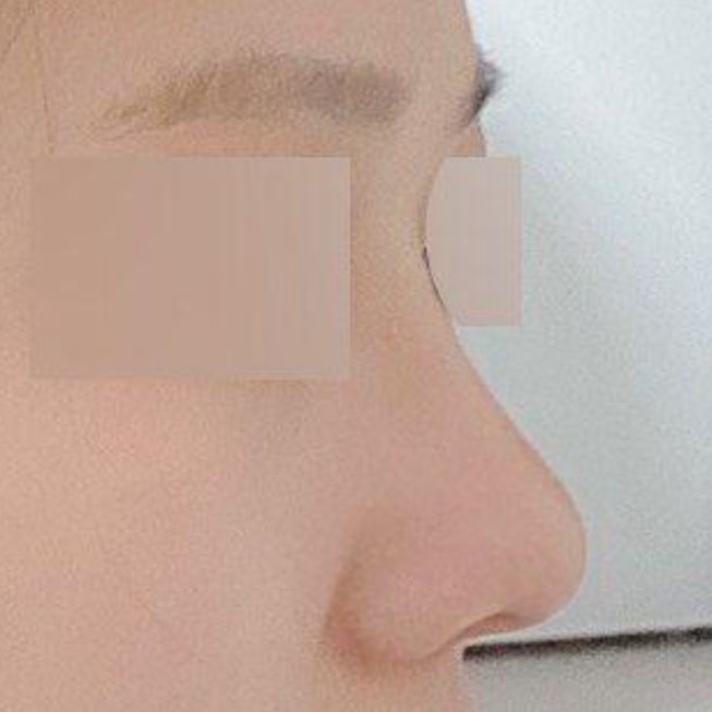 Sống mũi cao lên giúp khuôn mặt nhìn nghiêng cũng đẹp hơn và có chiều sâu hơn!