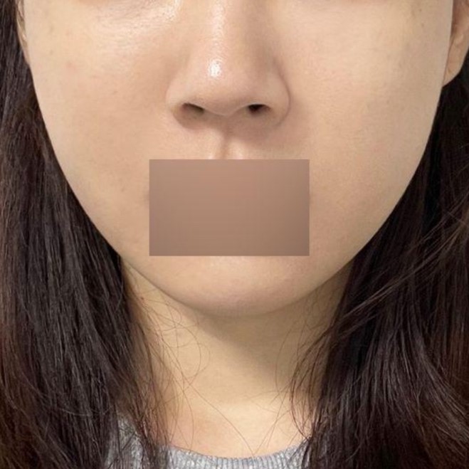 Ngày đầu tiên thực hiện căng chỉ tại bệnh viện thẩm mỹ Weavers