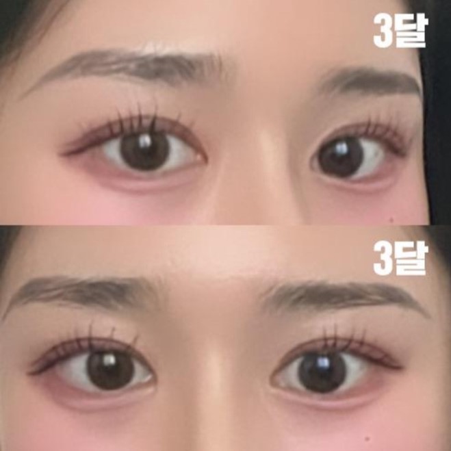 Mình đã phẫu thuật cắt mí được 3 tháng rồi.